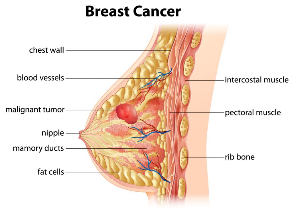 Diagram of breast cancer